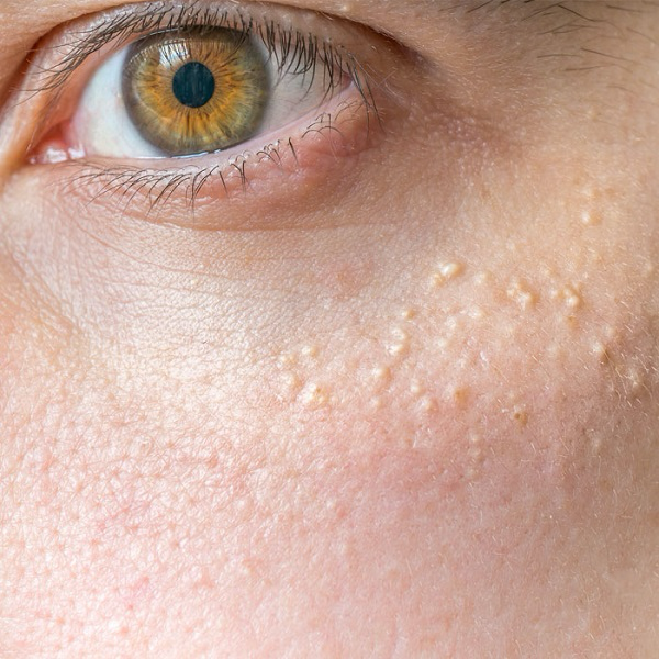 میلیا یک بیماری پوستی شایع است که معمولاً در نواحی صورت، به‌ویژه اطراف چشم و گونه‌ها مشاهده می‌شود. این اختلال پوستی باعث بروز جوش‌های سفید یا زردرنگی بر روی پوست می‌شود که به طور عمده در کودکان و بزرگسالان دیده می‌شود. اگر شما نیز به دنبال اطلاعات بیشتر در مورد میلیا هستید و می‌خواهید بدانید چگونه می‌توانید از شر آن خلاص شوید، ادامه مطلب را از دست ندهید.