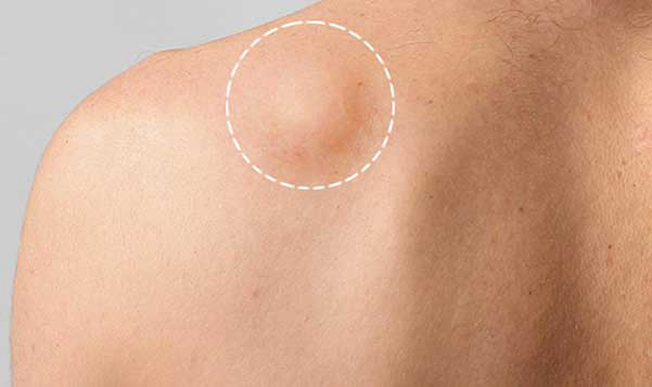 لیپوم یا غده چربی یکی از شایع‌ترین توده‌های خوش‌خیم بدن است که معمولاً در زیر پوست ایجاد می‌شود. این توده‌ها از سلول‌های چربی تشکیل شده‌اند و بیشتر در قسمت‌هایی از بدن مانند گردن، پشت، شانه‌ها و بازوها ظاهر می‌شوند. اگرچه این نوع توده‌ها به‌طور معمول خطرناک نیستند، اما در برخی موارد می‌توانند باعث ناراحتی و نگرانی شوند. در این مقاله، به بررسی علل، علائم و روش‌های درمانی لیپوم می‌پردازیم.